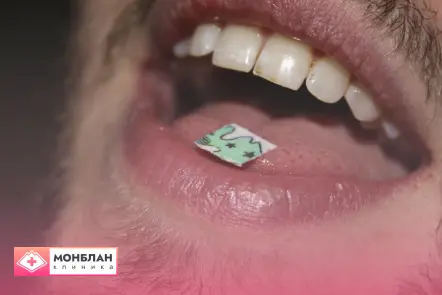 Лечение зависимости от употребления ЛСД